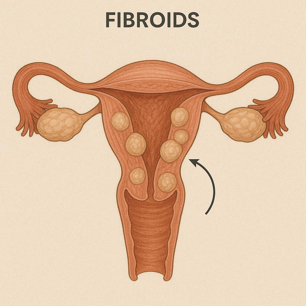Homeopathy Medicines for Fibroids Treatment 