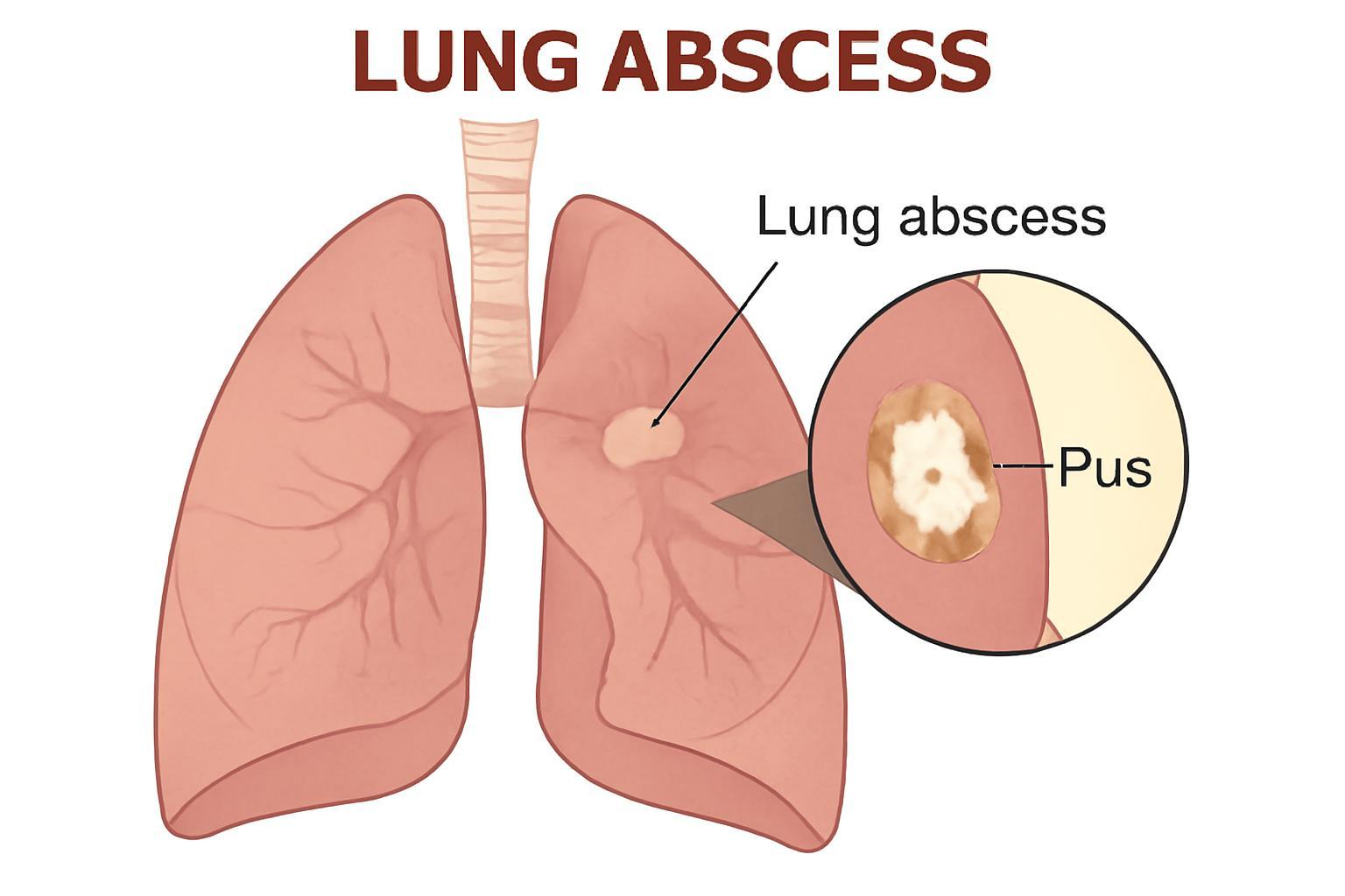 Homeopathy Medicines for Lung Abscess Treatment
