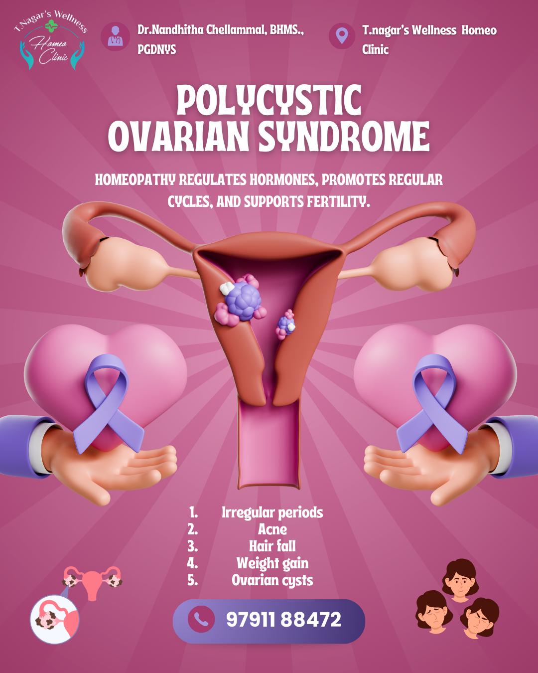 Homeopathy Medicines for Polycystic Ovarian Syndrome Treatment