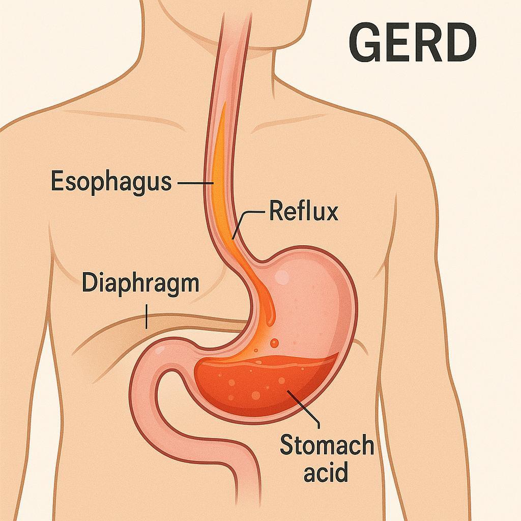 Homeopathy Medicines for Gastroesophageal Reflux Disease Treatment