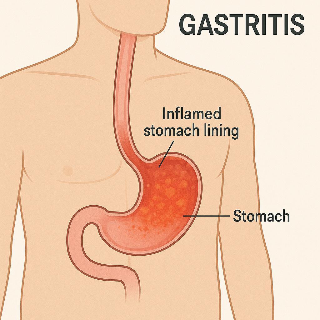 Homeopathy Medicines for Gastritis Treatment