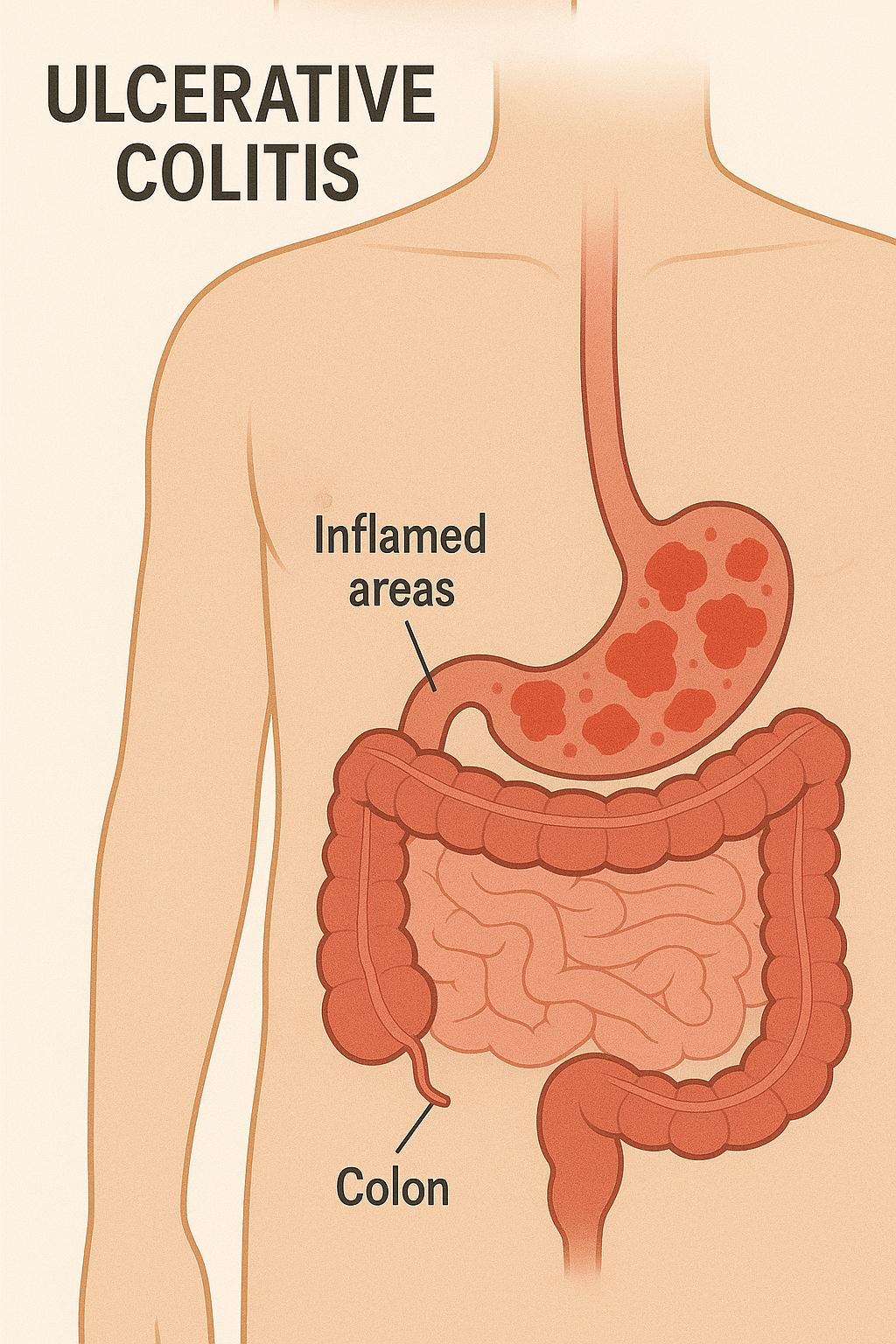 Homeopathy Medicines for Ulcerative Colitis Treatment