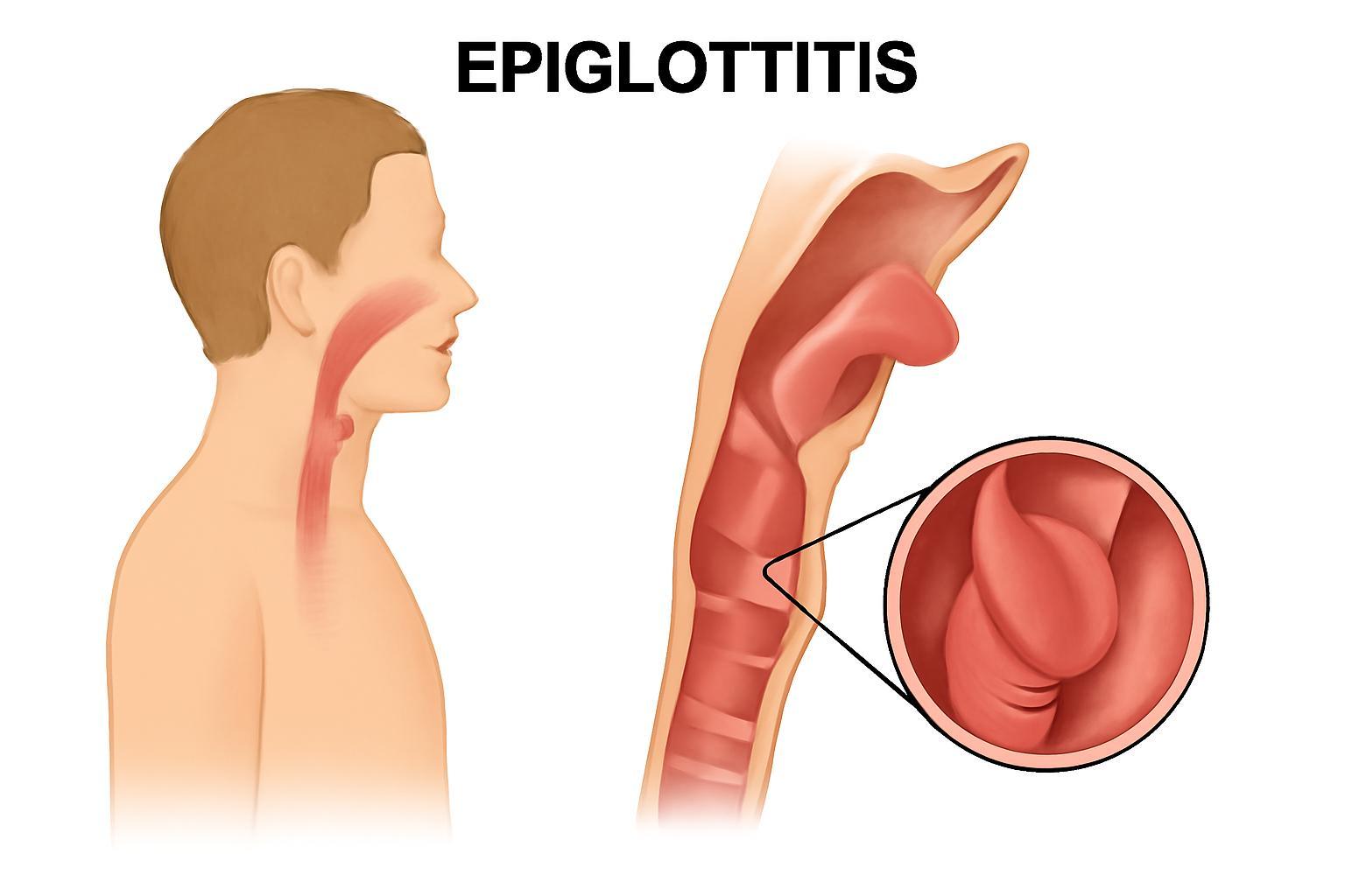 Homeopathy Medicines for Epiglottitis Treatment 