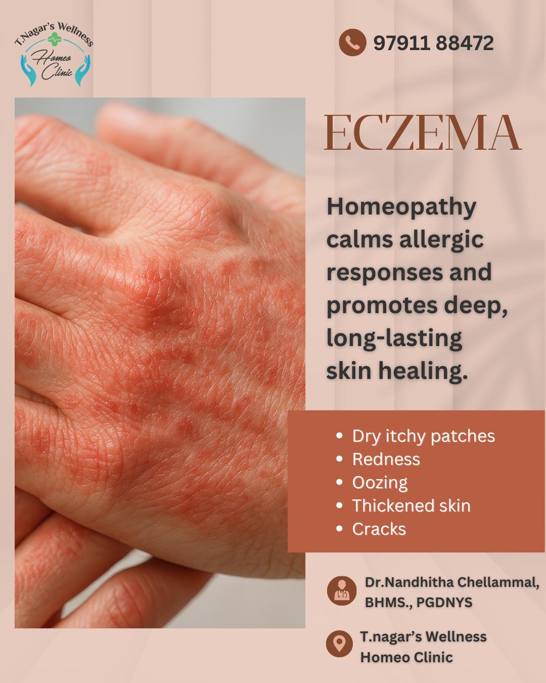 Homeopathy Medicines for Eczema Treatment 